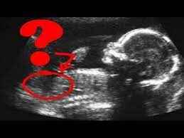 ultrasound-report-boy-girl-kaise-pta-kre-in-hindi (1)