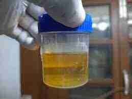 Urine-me-protein-aana-ayurvedic-ilaj (1)